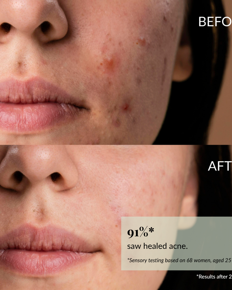Close-up of a woman's lower face showing acne before use (top) and clearer skin after using IREN Shizen CLEARER DAYS Anti-Blemish Serum (bottom), with text stating 91% saw healed acne after two weeks. #show-lang-en
