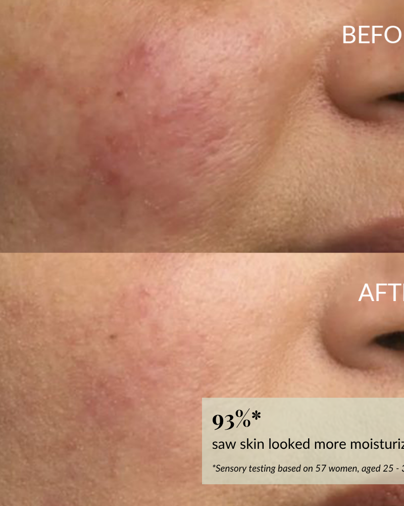 Close-up of a woman's cheek before and after skincare, showing reduced redness and smoother skin after using IREN Shizen DROP OF DEW Moisturizing Facial Oil. 93% saw more moisturized skin; formulated with cold-pressed oils for barrier repair.
#show-lang-en