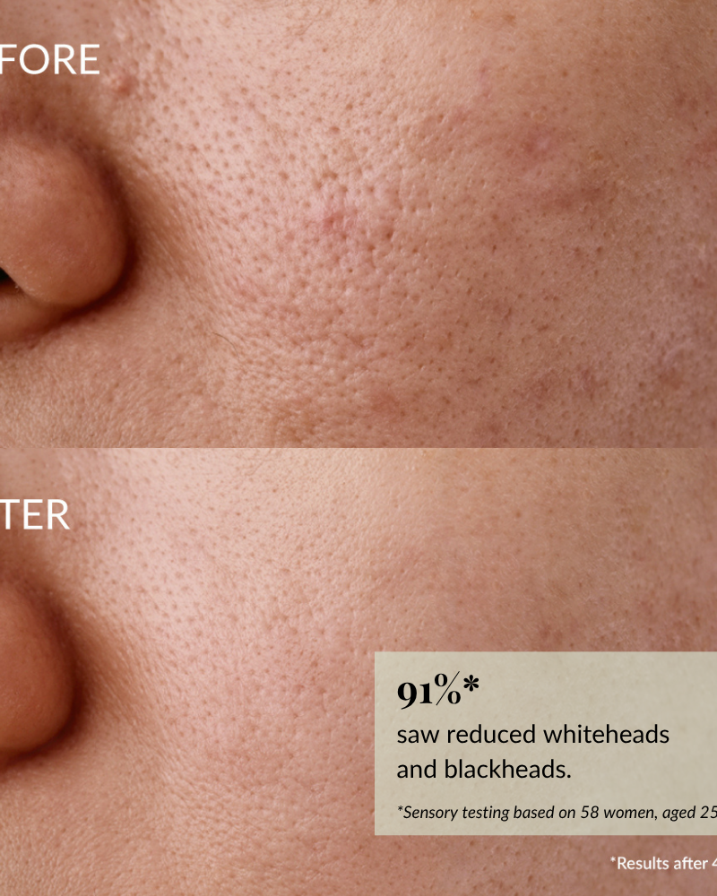 Close-up of a cheek and nose shows visible pores and blemishes before using IREN Shizen GLOW-GETTER Renewal Serum, and clearer, smoother skin after. Text highlights 91% improvement. #show-lang-en