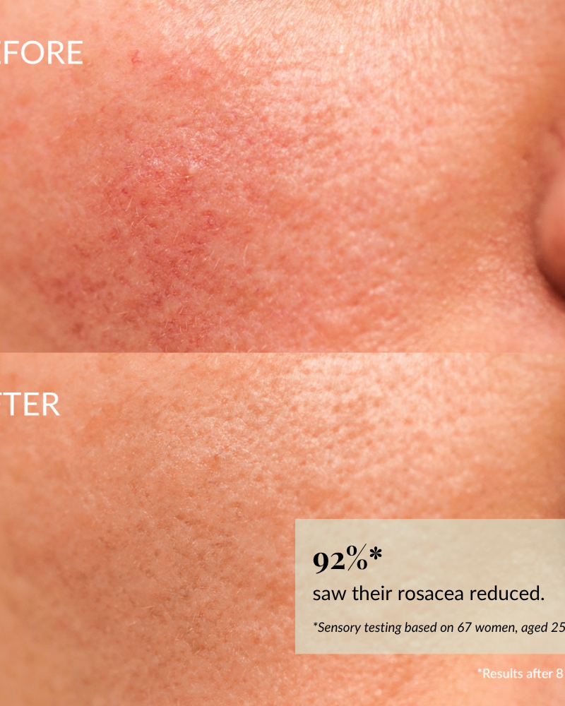 Close-up of sensitive skin shows redness and texture in the "before" image, while the "after" image reveals smoother, clearer skin with reduced rosacea. Text: 92% saw improvement after 8 weeks using IREN Shizen KEEP CALM Soothing Serum. #show-lang-en