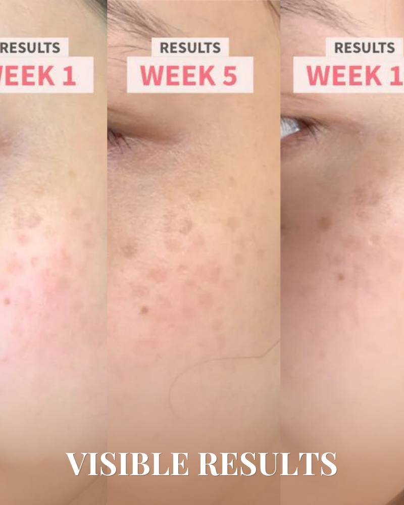 Close-up of a cheek at week 1, 5, and 10 after using IREN Shizen SKIN GENIE PRO Cleansing Brush + LED Light Therapy shows visible reduction in dark spots and uneven tone. Text: "VISIBLE RESULTS. #show-lang-en