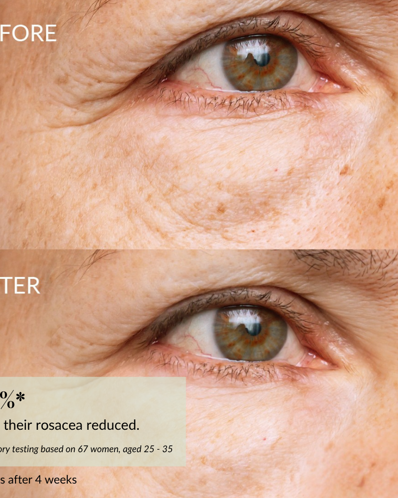 Close-up "Before" and "After" images reveal reduced redness, smoother skin, and brighter under-eyes after using IREN Shizen’s SKIN REBOOT Antioxidant Serum. Text highlights rosacea improvement and diminished dark circles. #show-lang-en