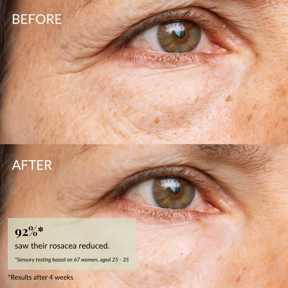 Close-up "Before" and "After" images reveal reduced redness, smoother skin, and brighter under-eyes after using IREN Shizen’s SKIN REBOOT Antioxidant Serum. Text highlights rosacea improvement and diminished dark circles.