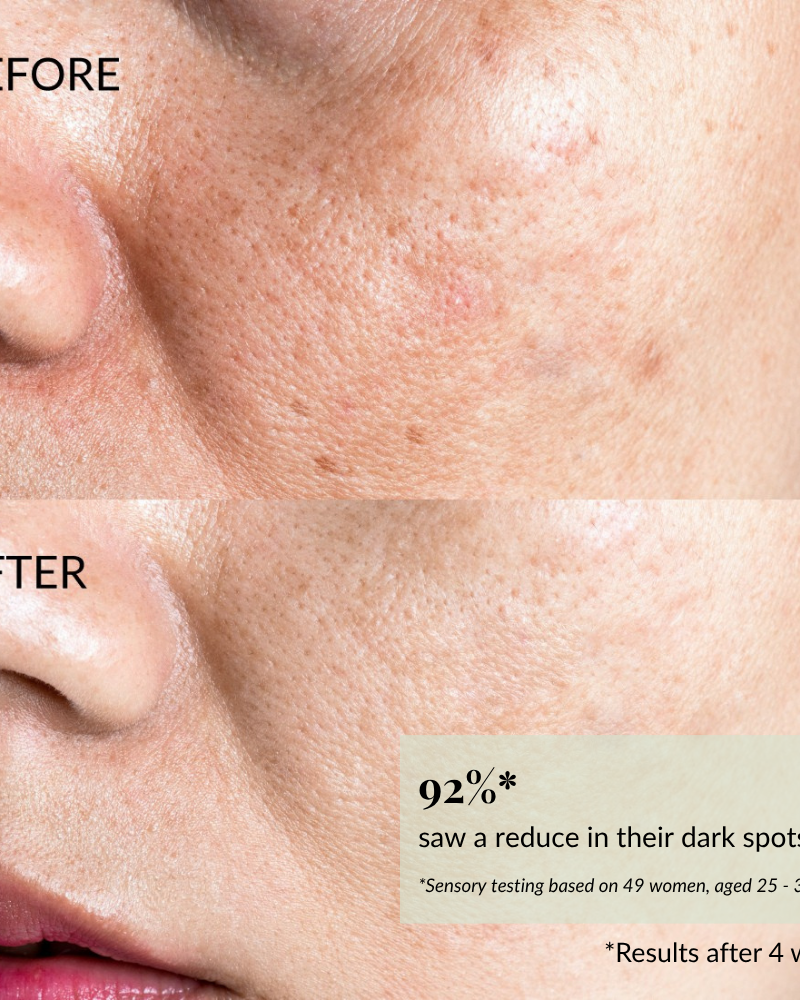 Close-up of a cheek with fewer dark spots and smoother skin after using STAR LIGHT Brightening Serum by IREN Shizen; 92% saw reduced dark spots and improved hyperpigmentation in 4 weeks. #show-lang-en
