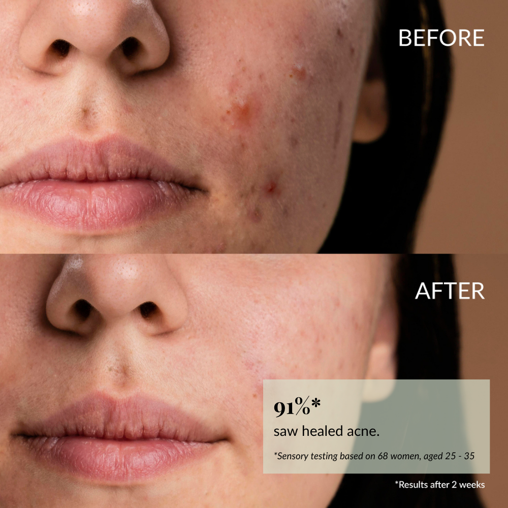 Close-up of a woman's lower face showing acne before use (top) and clearer skin after using IREN Shizen CLEARER DAYS Anti-Blemish Serum (bottom), with text stating 91% saw healed acne after two weeks.