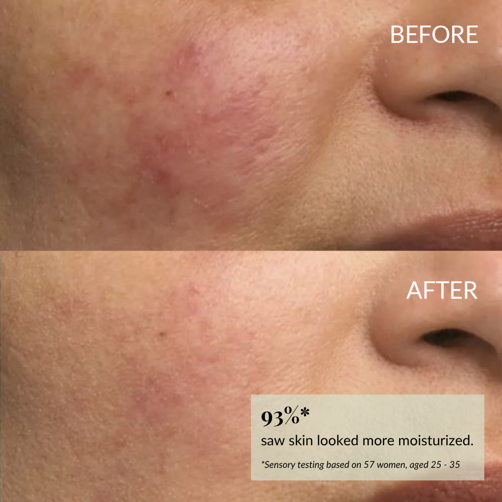 Close-up of a woman's cheek before and after skincare, showing reduced redness and smoother skin after using IREN Shizen DROP OF DEW Moisturizing Facial Oil. 93% saw more moisturized skin; formulated with cold-pressed oils for barrier repair.
#show-lang-en