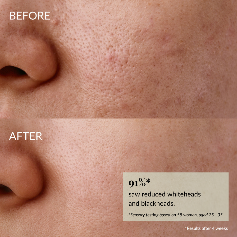 Close-up of a cheek and nose shows visible pores and blemishes before using IREN Shizen GLOW-GETTER Renewal Serum, and clearer, smoother skin after. Text highlights 91% improvement.