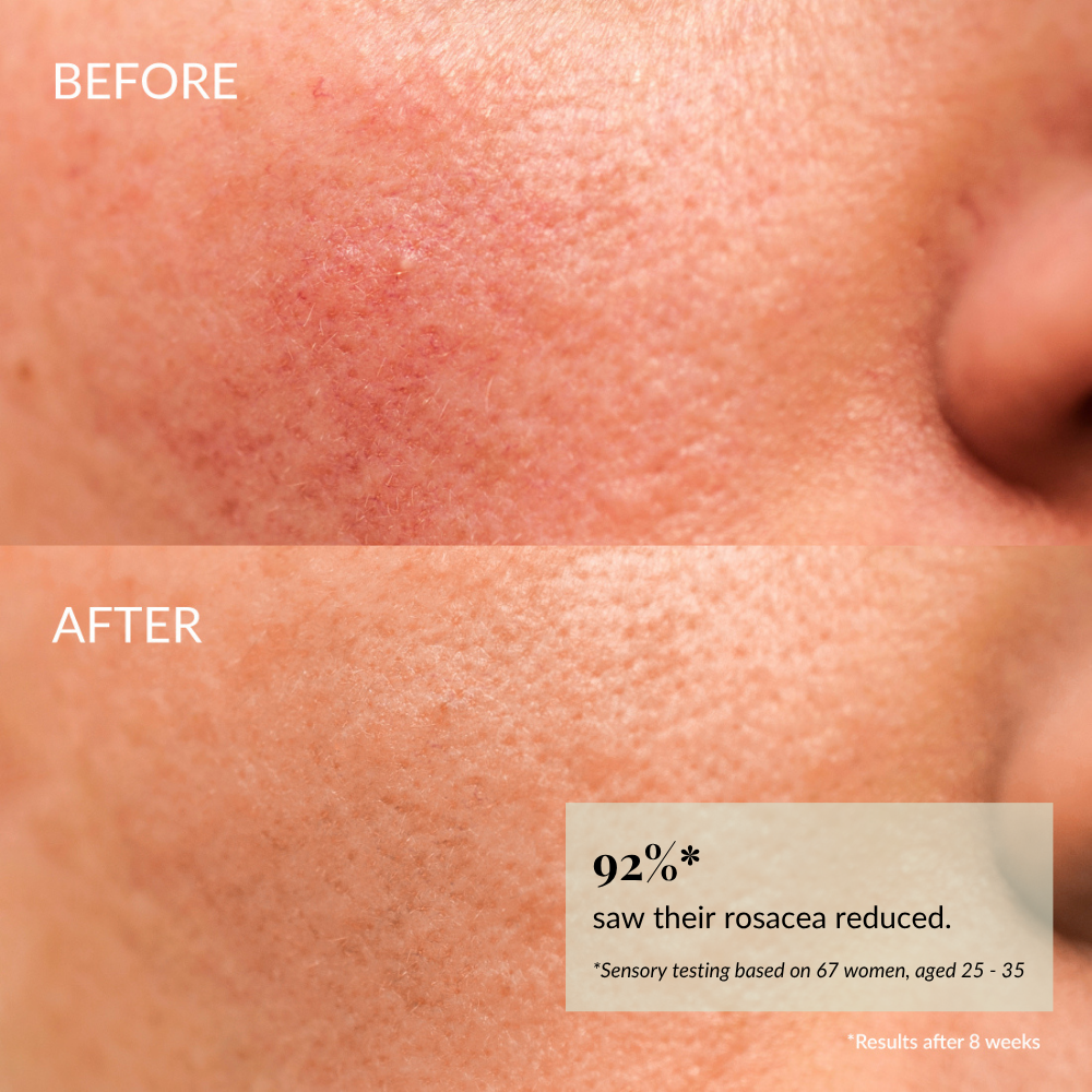Close-up of sensitive skin shows redness and texture in the "before" image, while the "after" image reveals smoother, clearer skin with reduced rosacea. Text: 92% saw improvement after 8 weeks using IREN Shizen KEEP CALM Soothing Serum.