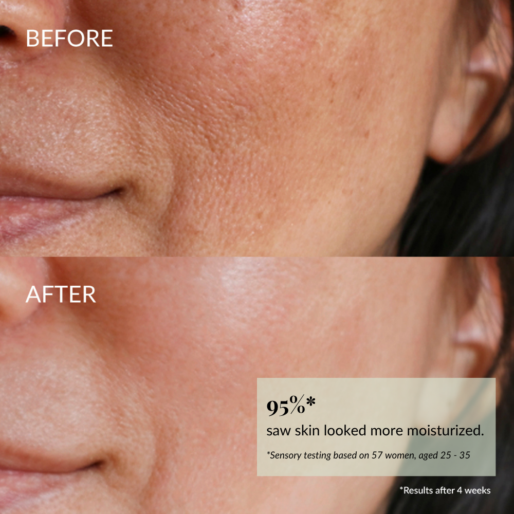 Close-up of a woman's cheek and mouth area shows plumper, less dry skin in the "after" image, demonstrating the moisturizing results of IREN Shizen QUENCH-UP Hydrating Serum.
