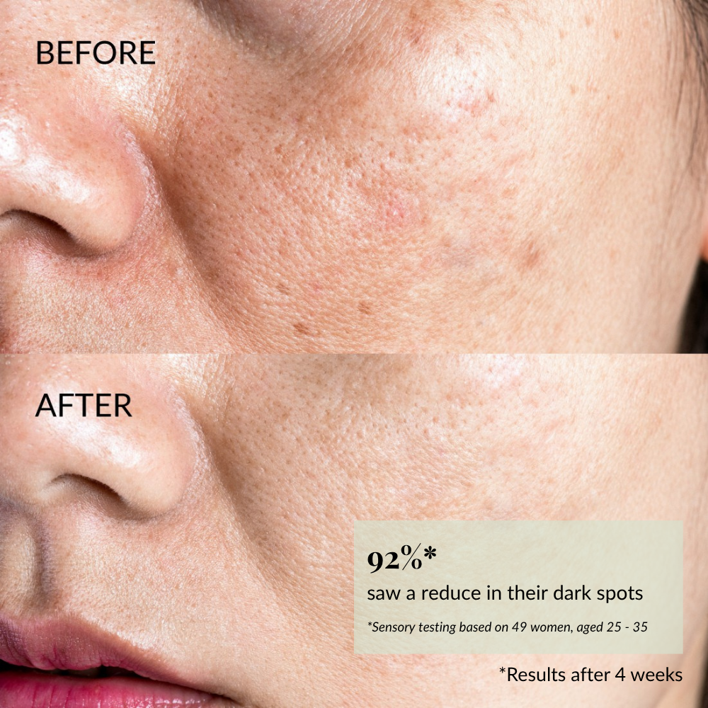 Close-up of a cheek with fewer dark spots and smoother skin after using STAR LIGHT Brightening Serum by IREN Shizen; 92% saw reduced dark spots and improved hyperpigmentation in 4 weeks.